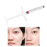 (B) Small Molecule Hyaluronic Acid Filler, Lips/Nose/Cheeks, Cross-Linked Hyaluronic Acid, Lip Area